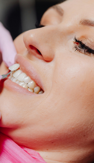 Dental Fillings